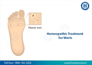 Homeopathy Treatment for Warts in jubilee hills